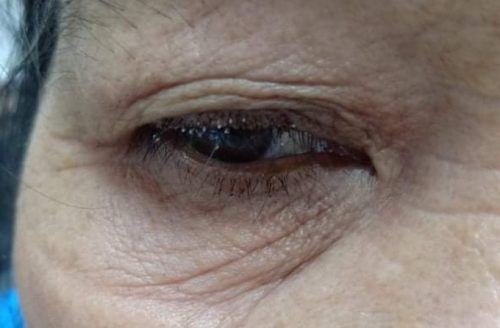 Mi mắt chứa đầy rận mu của bệnh nhân trước khi điều trị