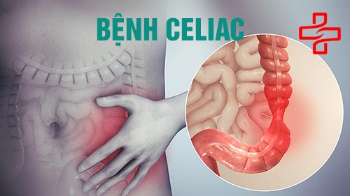 Đau bụng dưới ở nữ do mắc bệnh Celiac