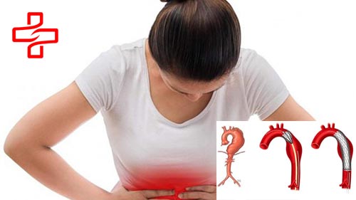 Đau bụng dưới bên trái ở nữ có thể do phình động mạch chủ