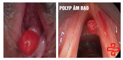 Polyp âm đạo gây rối loạn kinh nguyệt ở nữ giới