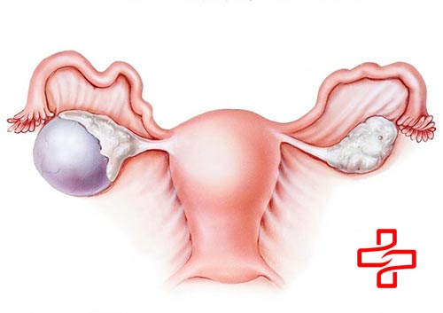 U nang buồng trứng khiến nữ giới vừa có kinh lại có kinh tiếp
